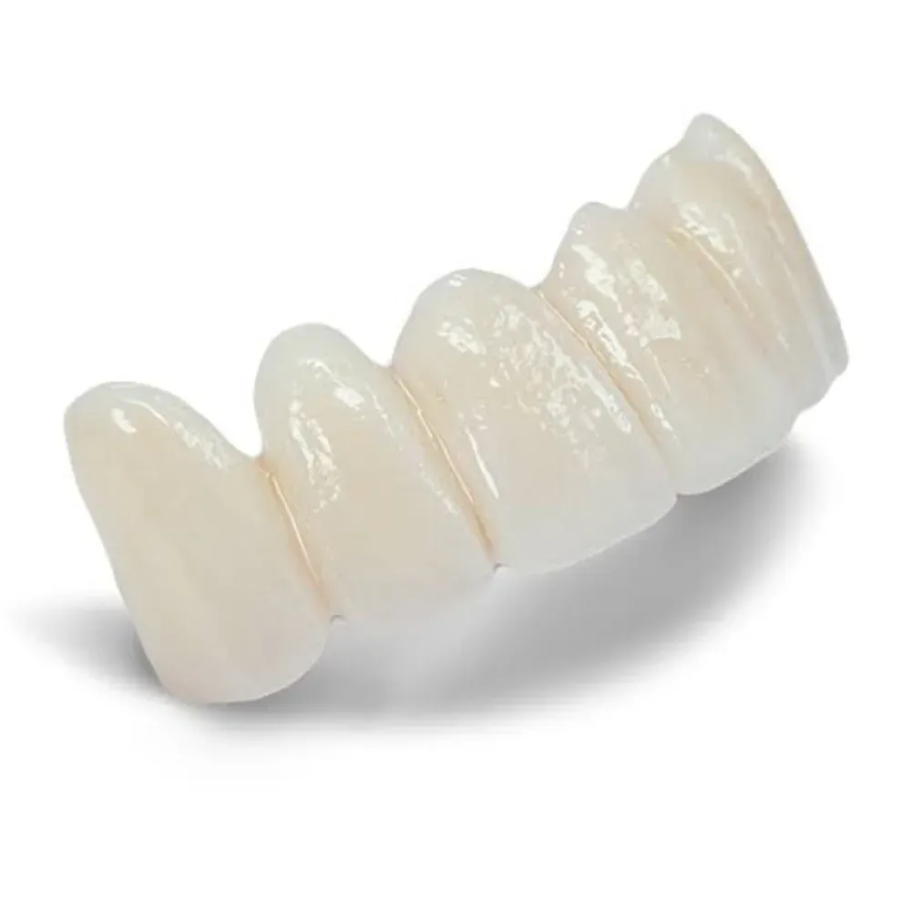 Conventional two-abutment zirconia bridge on the model