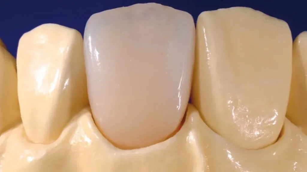 Ceramic crown seated on a gingiva model — clinic-standard restorative work