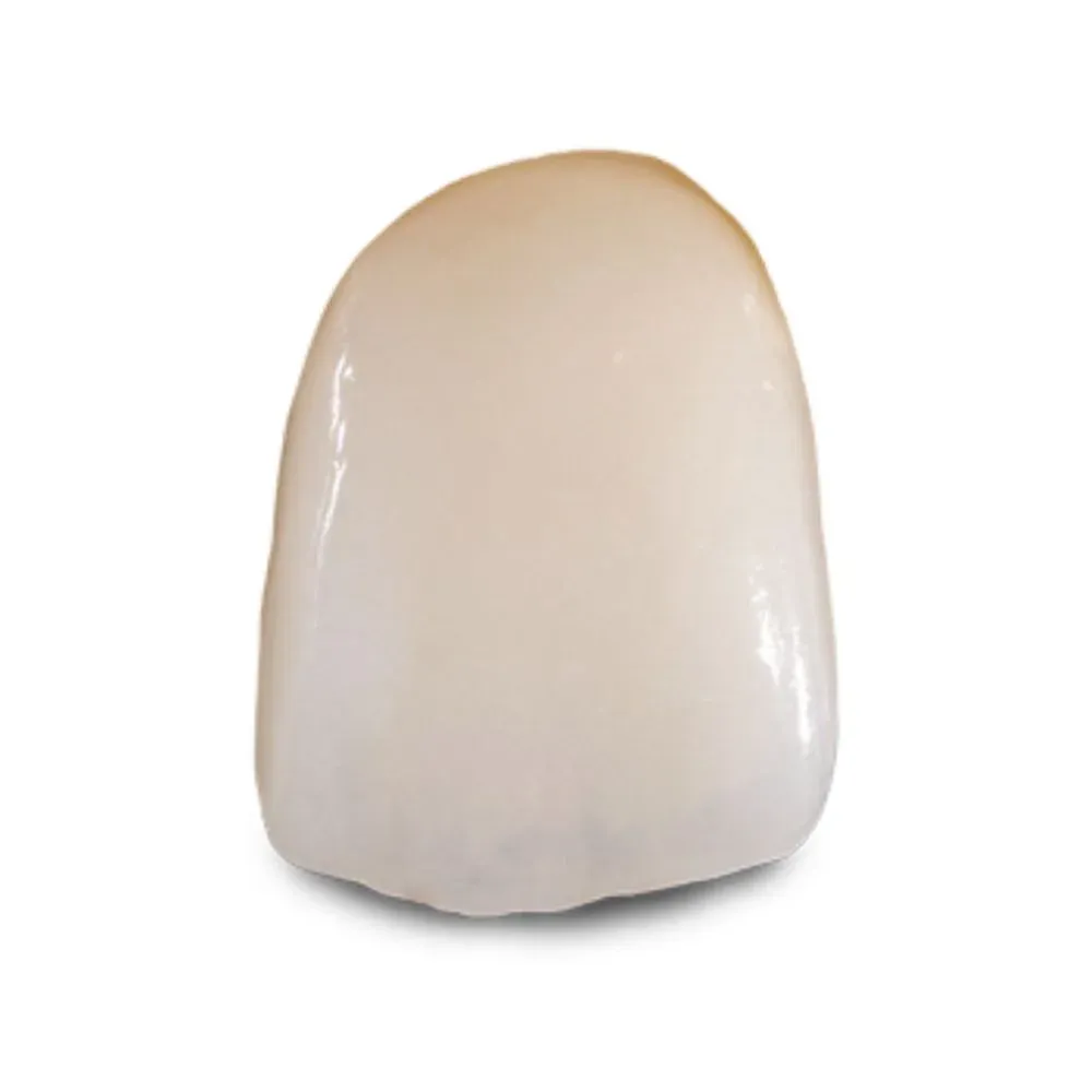 IPS e.max anterior crown under daylight-balanced light