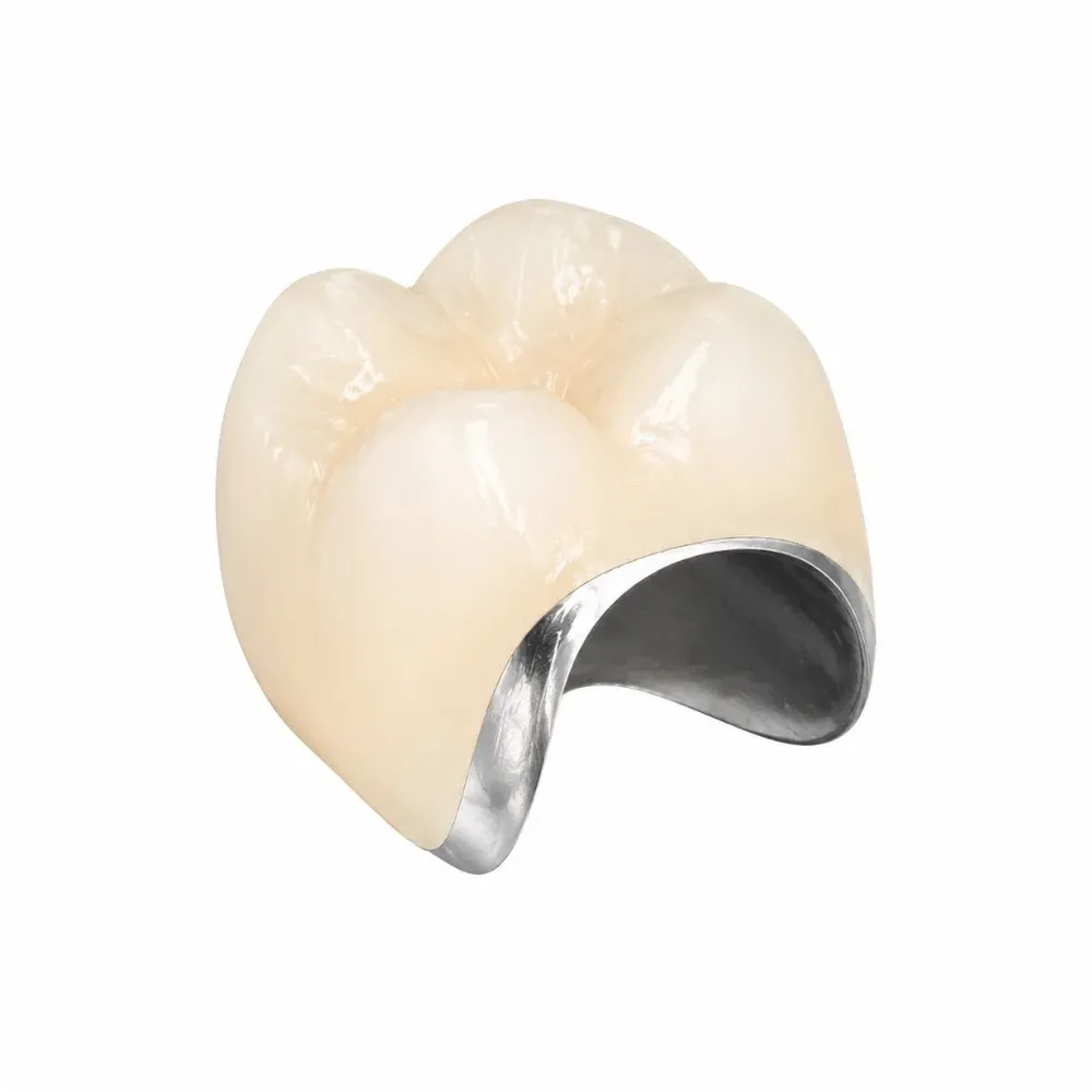 PFM crown, porcelain layered over a cast metal coping