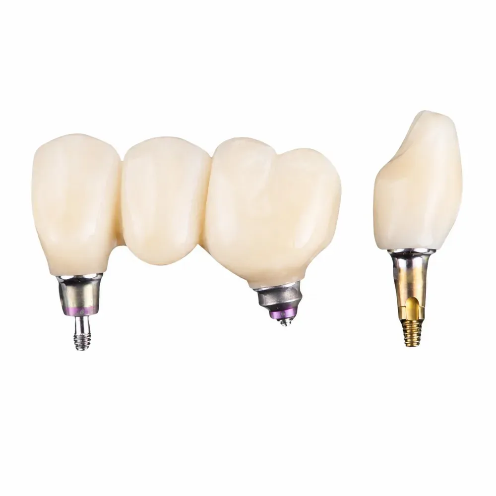 Bridge restored on implants, no load on natural teeth