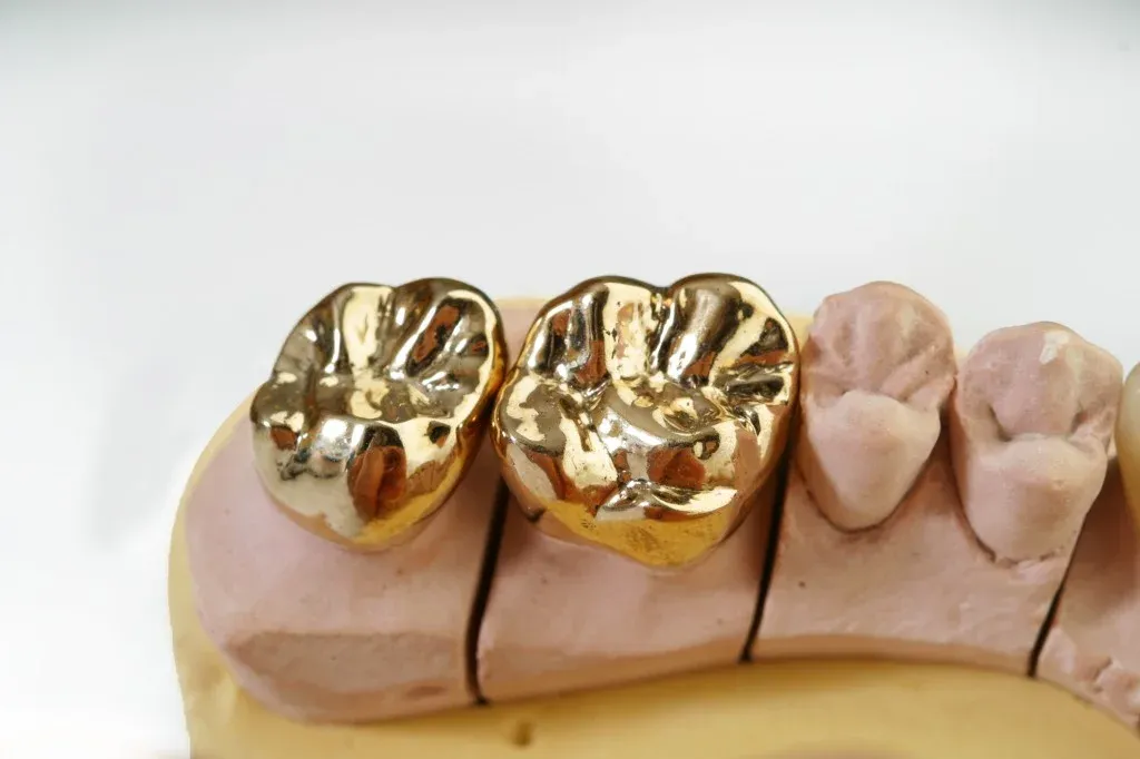A full cast gold crown seated on a posterior second molar