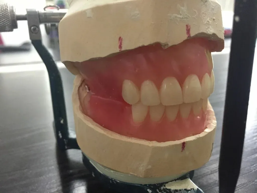 A full denture mounted on an articulator at the bench