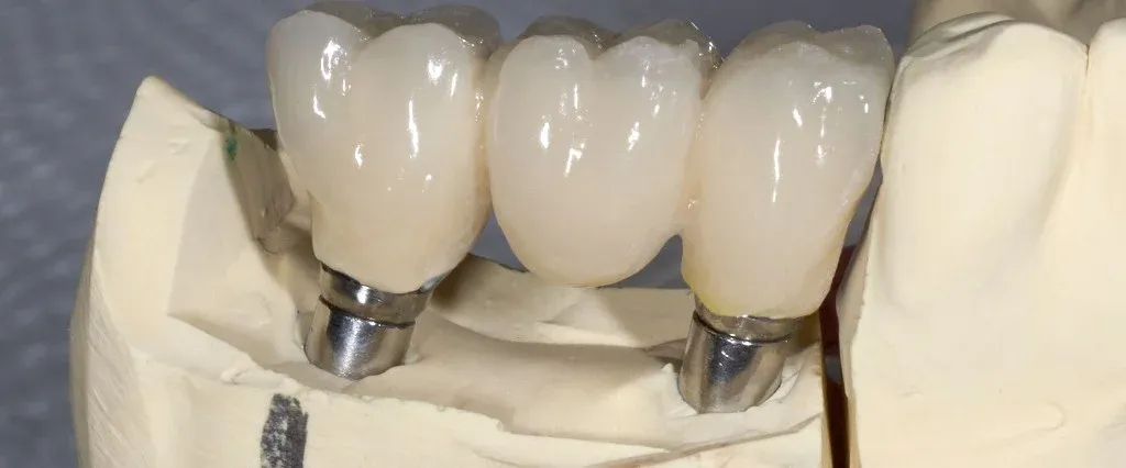 A screw-retained implant bridge seated on the master model