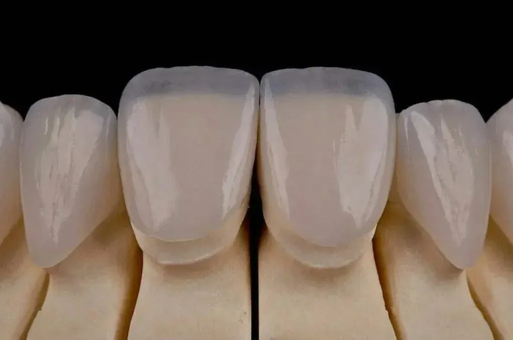Feldspathic porcelain veneers built up in layers on the bench