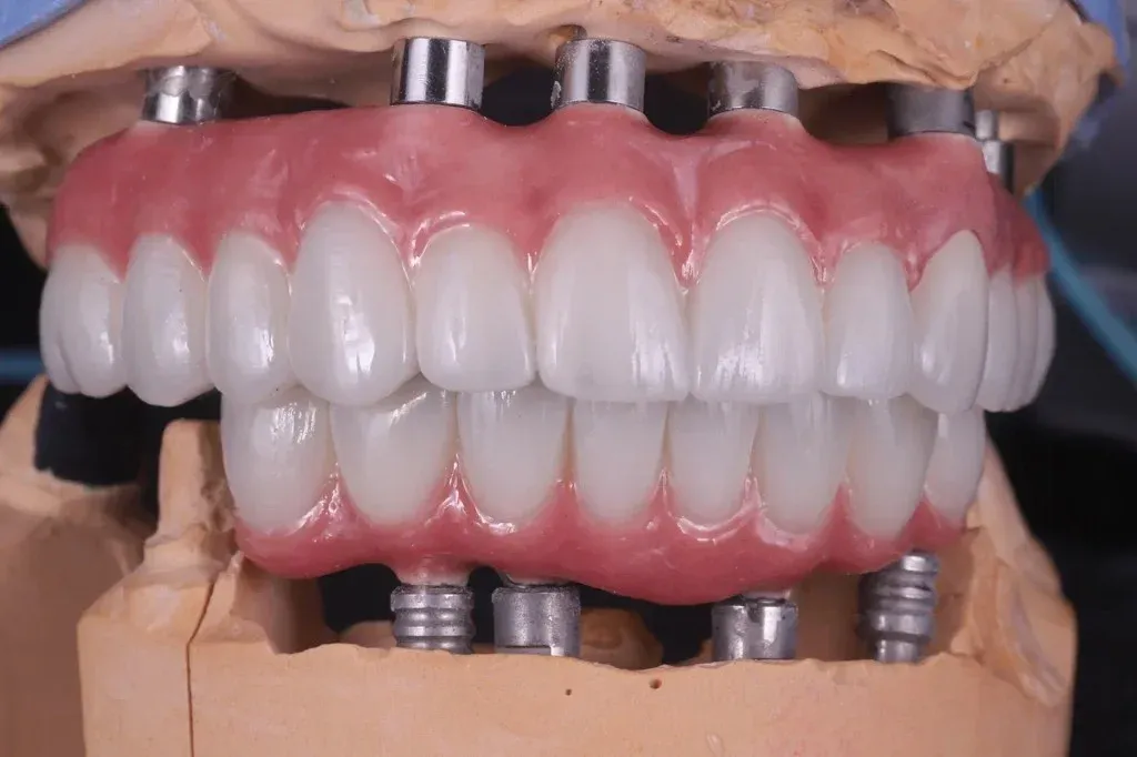Fixed full-arch hybrid seated on multi-unit abutments