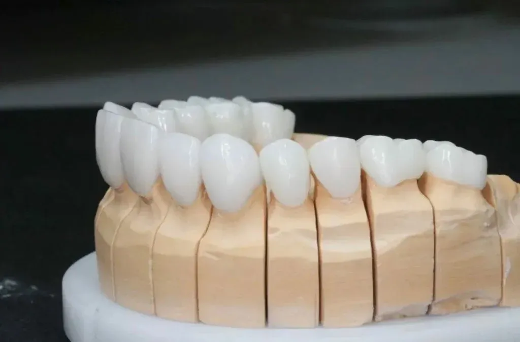 IPS e.max anterior crowns showing translucency and characterization