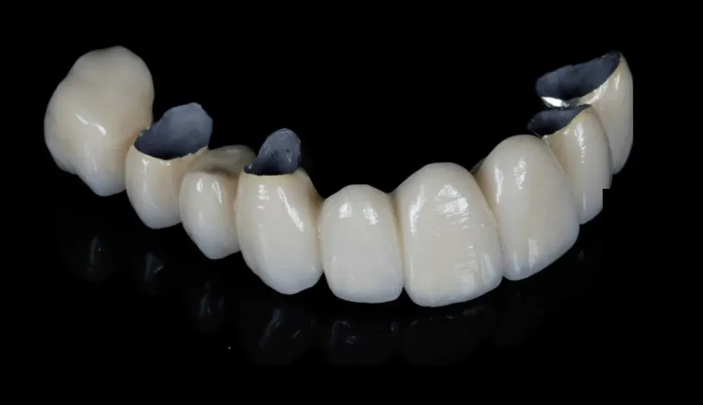 PFM crowns, cast copings veneered with stratified porcelain