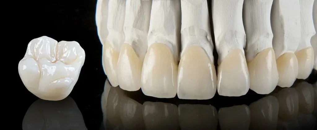 PFZ crowns, zirconia cores layered with porcelain, on the master model