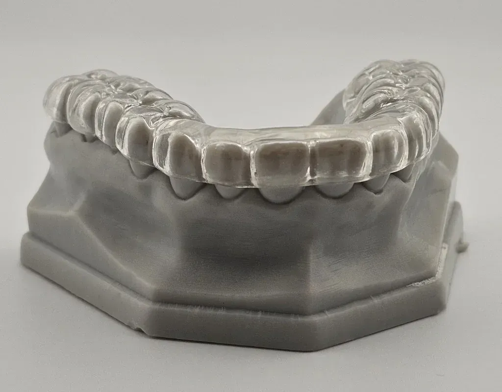 Trial mockup seated over the natural teeth for a chairside preview