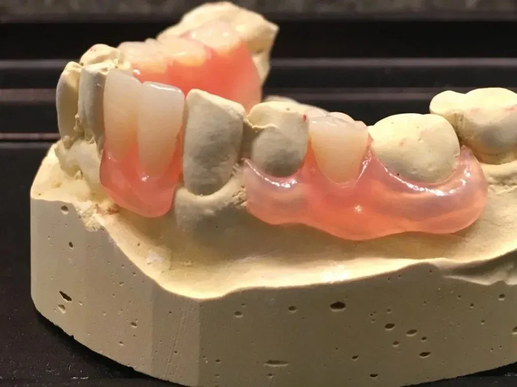 Valplast flexible nylon partial with tissue-toned clasps