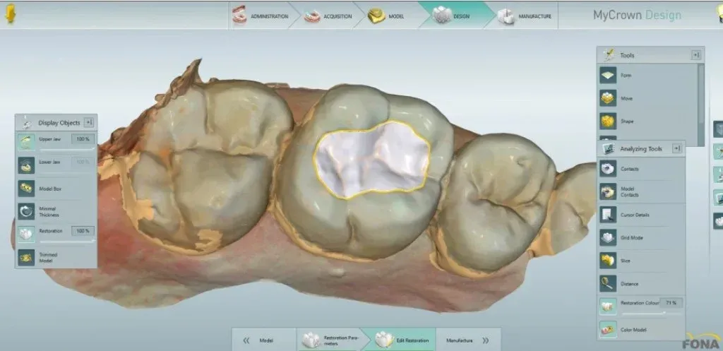 Close-up of a traced margin line on a prepped tooth in the design software