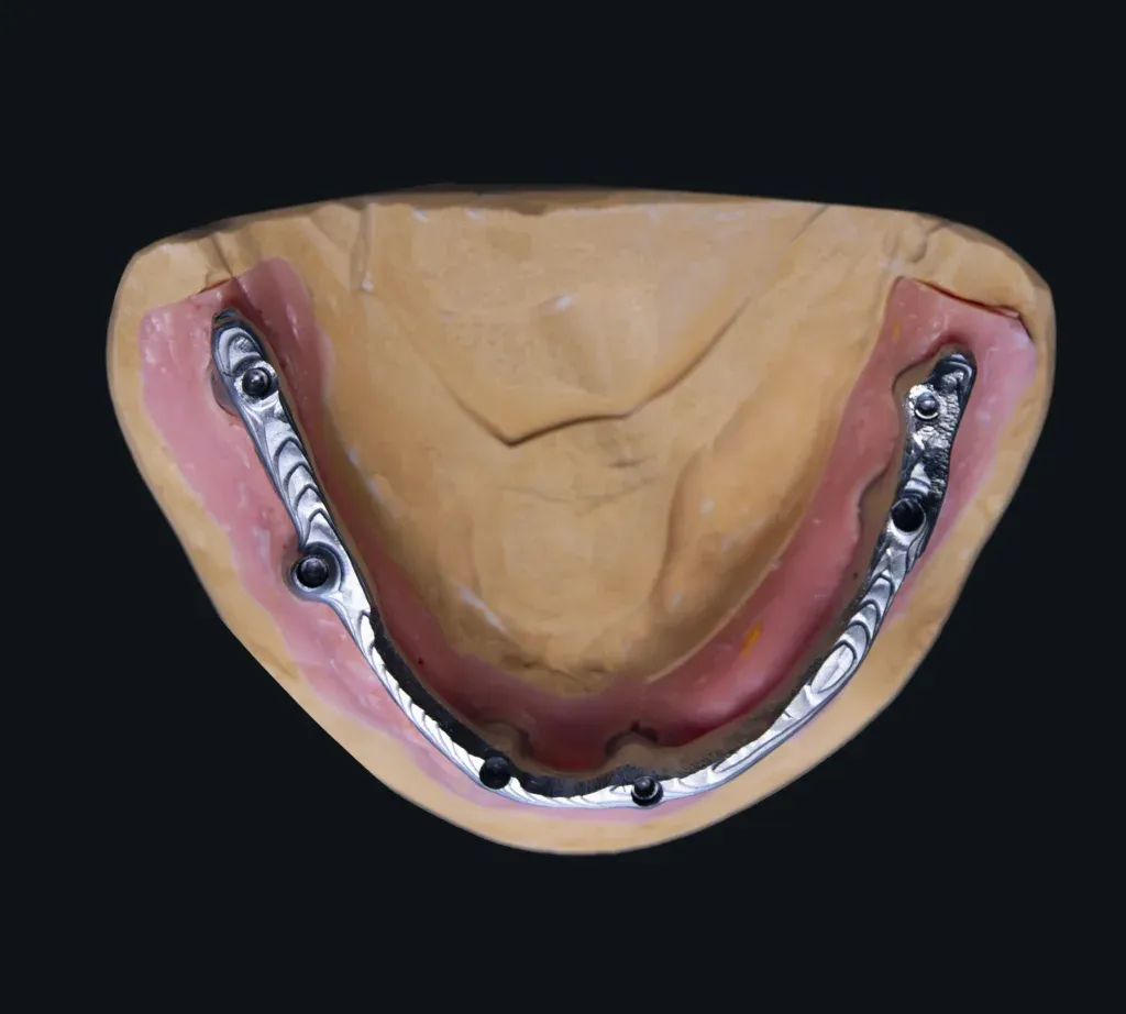 Milled titanium framework verified for passive fit on the master model
