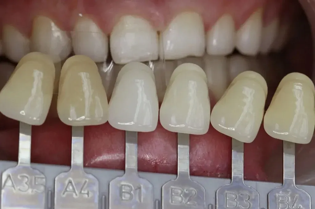 Single central incisor shade being matched at the bench against the adjacent natural tooth