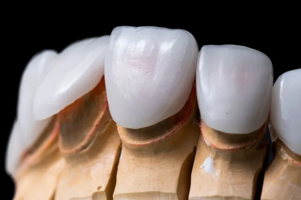 Feldspathic veneer and a monolithic e.max crown side by side for translucency contrast