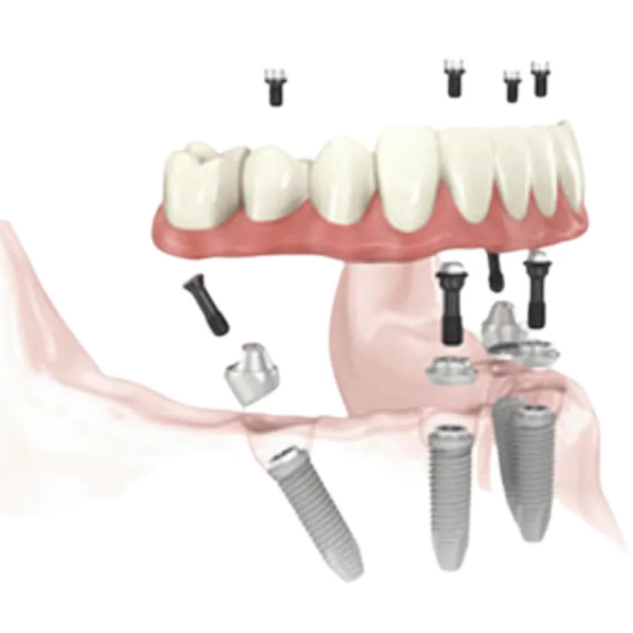 Full-arch All-on-X plan showing implant position and prosthetic space