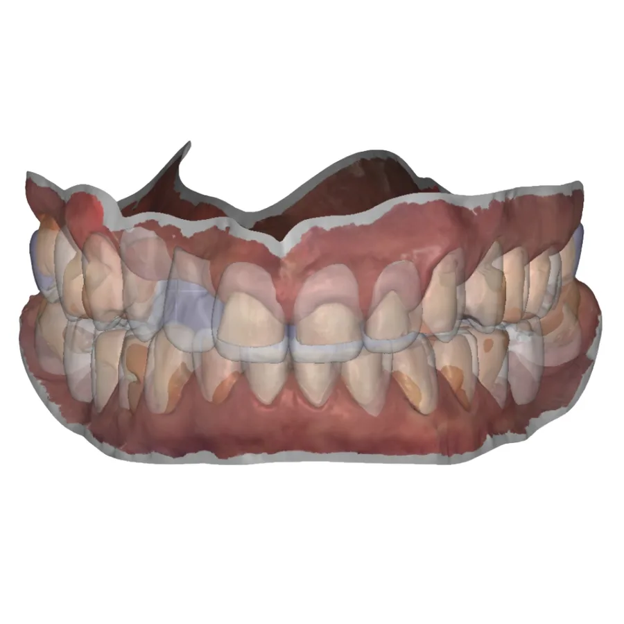 Digital diagnostic wax-up of an arch on screen